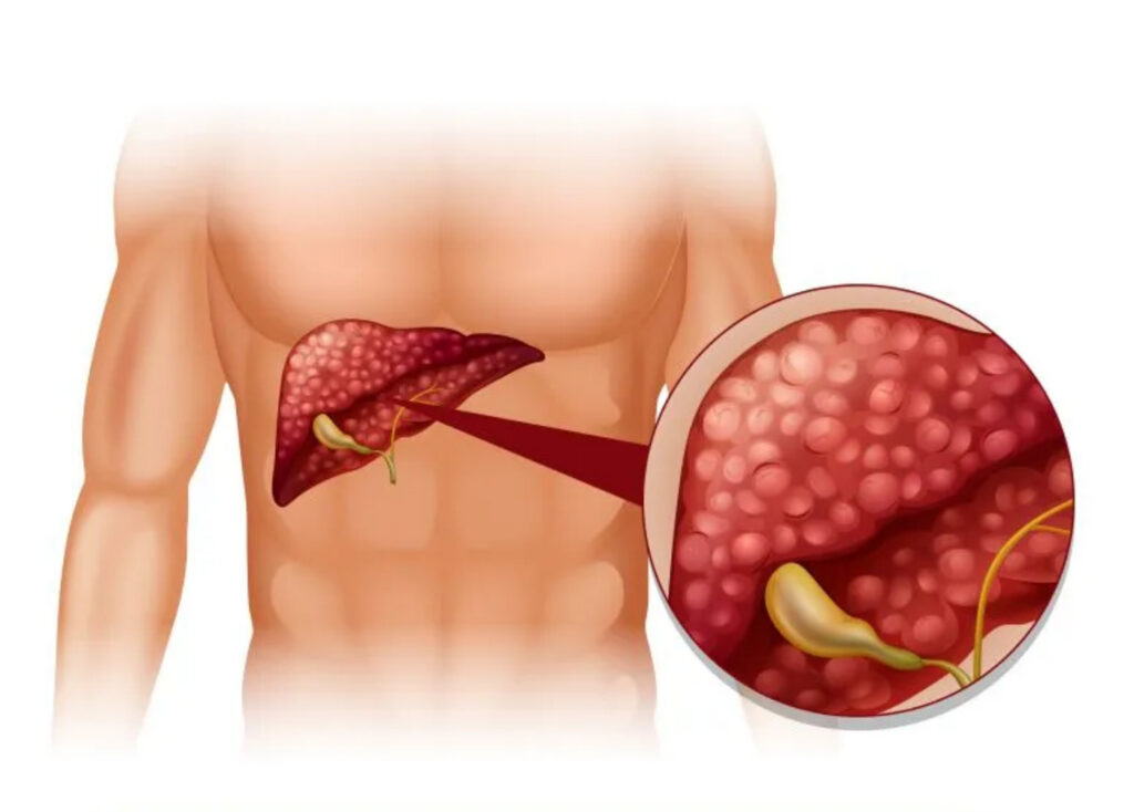 SỎI TÚI MẬT: TRIỆU CHỨNG VÀ PHƯƠNG PHÁP ĐIỀU TRỊ